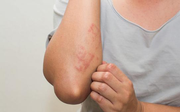 Người bệnh viêm da cơ địa nặng có thêm liệu pháp chữa trị