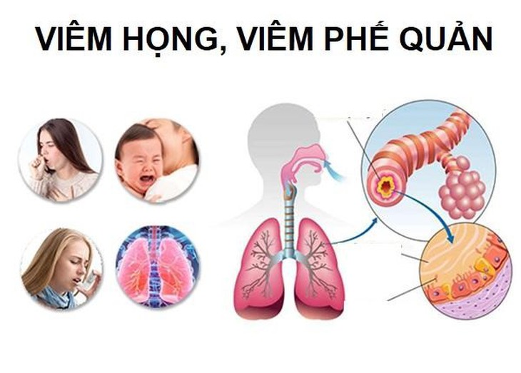 Đột phá mới hỗ trợ giảm ho do viêm họng, viêm phế quản, ho kéo dài - Ảnh 1.