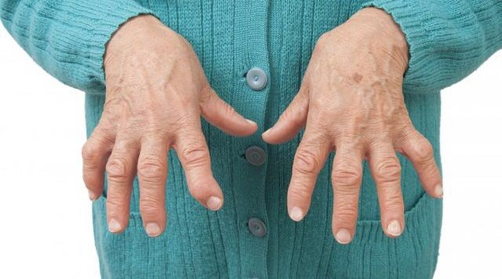 Viêm khớp vảy nến: Triệu chứng, nguyên nhân và cách điều trị - Ảnh 6.