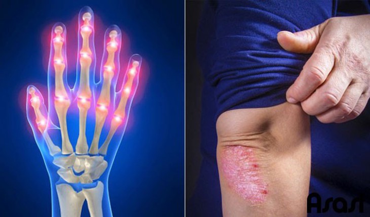 Viêm khớp vảy nến: Triệu chứng, nguyên nhân và cách điều trị - Ảnh 2.