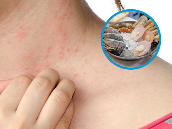 6 loại thực phẩm dễ gây dị ứng nhất ai cũng nên biết để phòng tránh - Ảnh 2. 6 loại thực phẩm dễ gây dị ứng nhất ai cũng nên biết để phòng tránh - Ảnh 2.