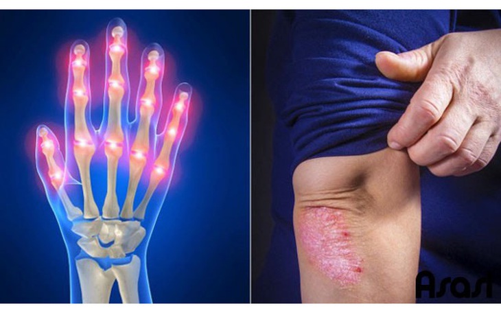 Viêm khớp vảy nến: Triệu chứng, nguyên nhân và cách điều trị