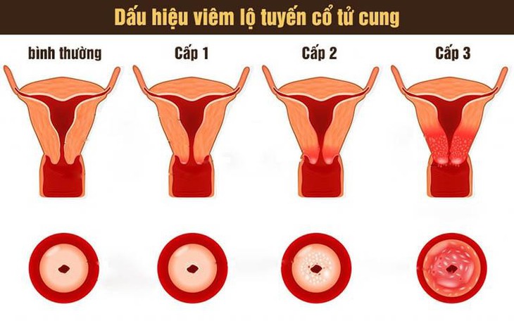 Cách hỗ trợ giảm nguy cơ viêm lộ tuyến cổ tử cung - Ảnh 1.