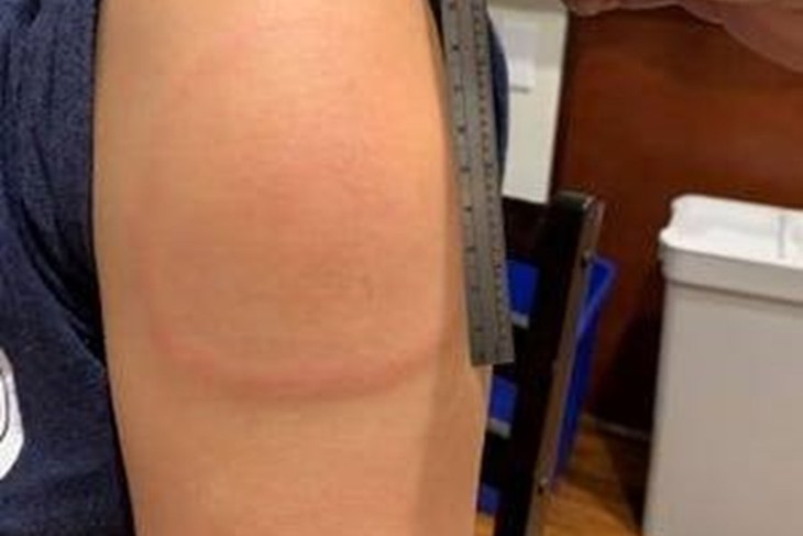 Phản vệ sau tiêm vaccine COVID-19, làm sao để giảm rủi ro? - Ảnh 1.