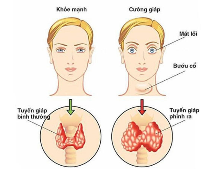 Bệnh Basedow và các biện pháp điều trị - Ảnh 1.