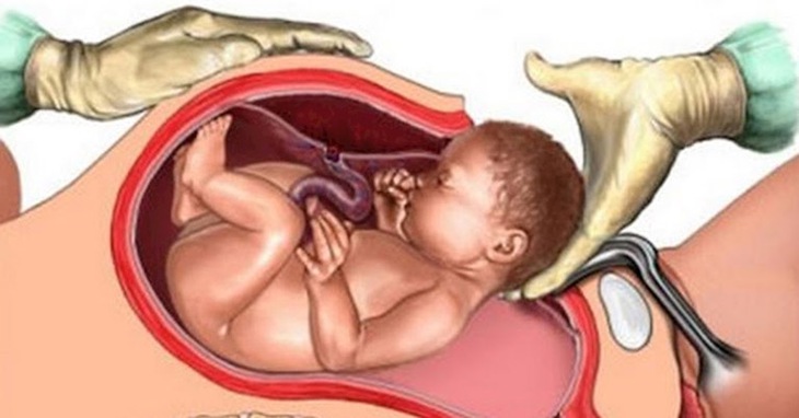 Nhiễm trùng hậu sản: Nguyên nhân, triệu chứng và điều trị  - Ảnh 1.