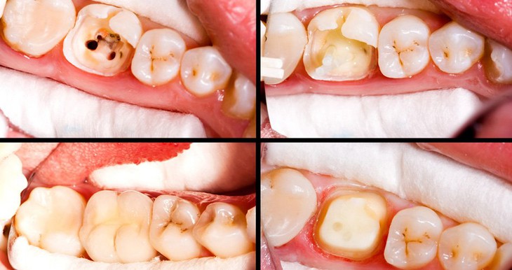 Đau nhức răng - Cảnh giác với viêm quanh cuống răng - Ảnh 6. Đau nhức răng - Cảnh giác với viêm quanh cuống răng - Ảnh 6.