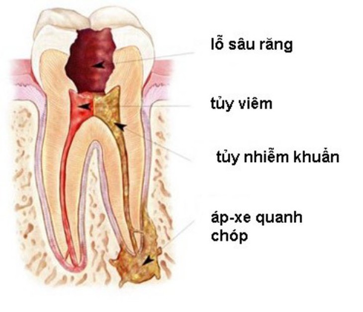Đau nhức răng - Cảnh giác với viêm quanh cuống răng - Ảnh 3. Đau nhức răng - Cảnh giác với viêm quanh cuống răng - Ảnh 3.
