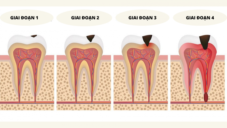 Đau nhức răng - Cảnh giác với viêm quanh cuống răng - Ảnh 5. Đau nhức răng - Cảnh giác với viêm quanh cuống răng - Ảnh 5.