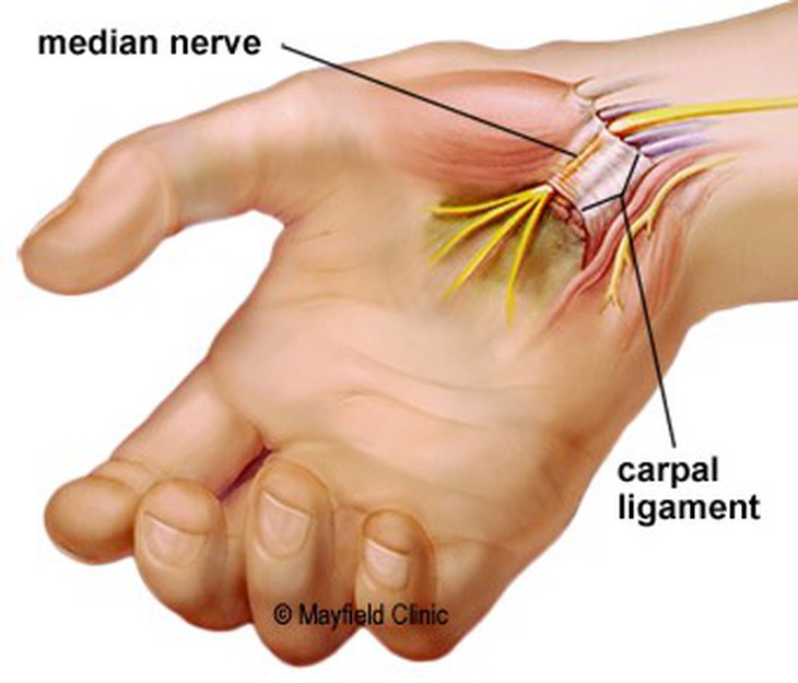 Các phương pháp điều trị hội chứng ống cổ tay - Ảnh 4.