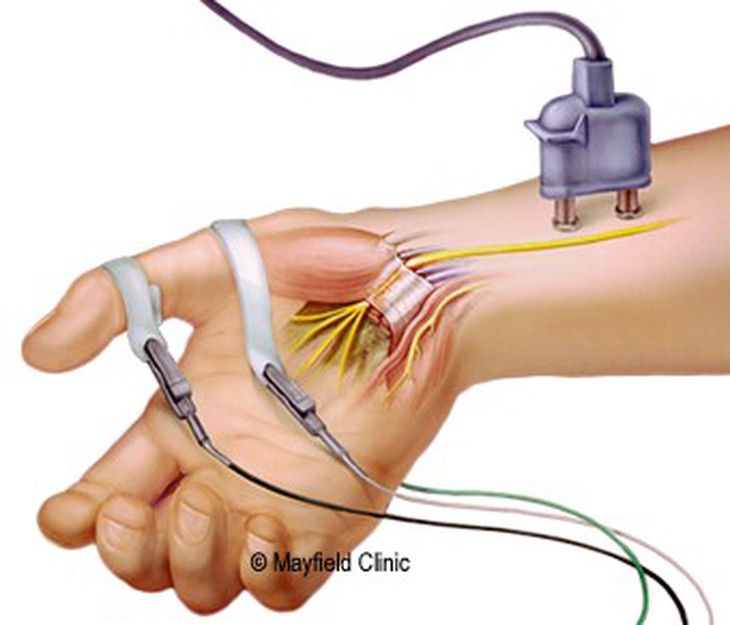 Sử dụng điện thoại, máy tính nhiều, cẩn thận mắc hội chứng ống cổ tay - Ảnh 9.