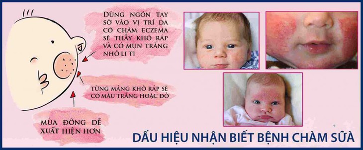 Chàm sữa ở trẻ em: Phân loại và xử trí đúng giải tỏa nỗi lo khi mùa đông về - Ảnh 3.
