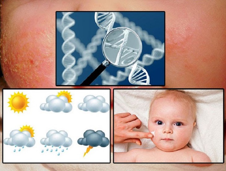 Chàm sữa ở trẻ em: Phân loại và xử trí đúng giải tỏa nỗi lo khi mùa đông về - Ảnh 6.