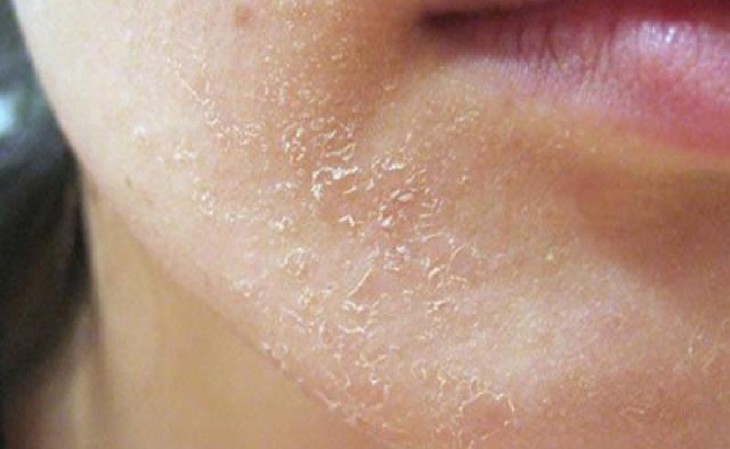 Dị ứng retinol, điều trị thế nào? - Ảnh 1.