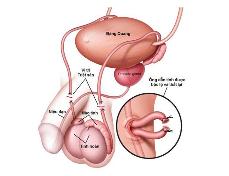 Sau thắt ống dẫn tinh có kiêng quan hệ tình dục không? - Ảnh 1.