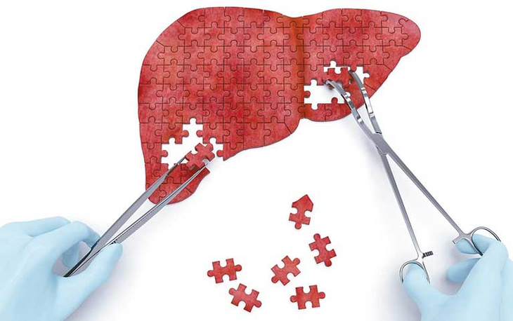 Suy gan - dễ mắc, khó chữa, đâu là giải pháp? - Ảnh 1.