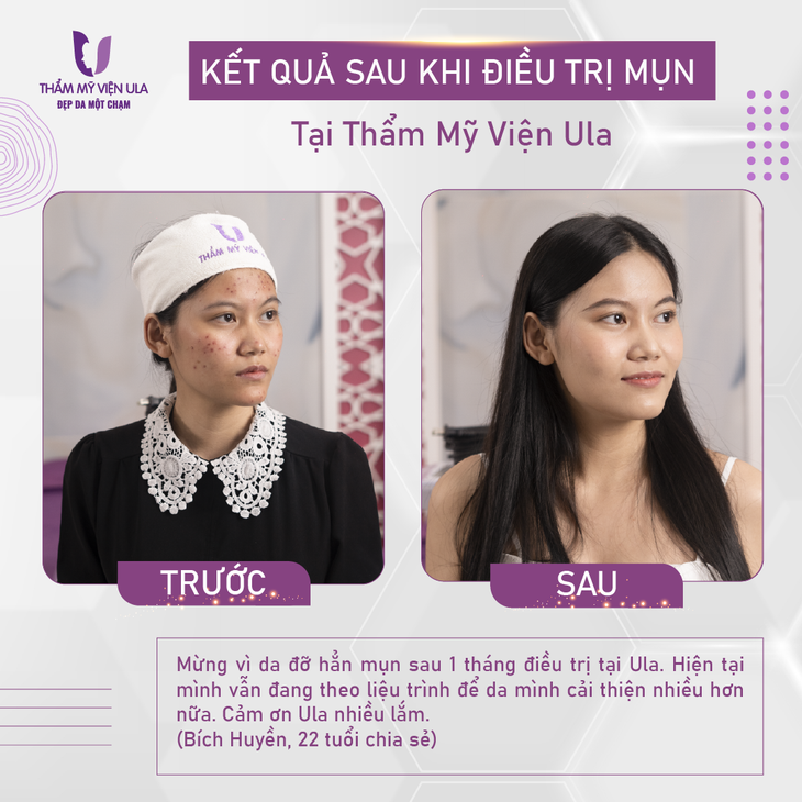Tự tin đón Tết, "xoá sạch" mụn thâm cùng Thẩm mỹ viện Ula - Ảnh 3.