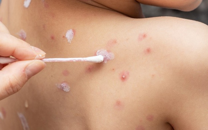 Bệnh thủy đậu: Dấu hiệu nhận biết và các thuốc chữa hiệu quả