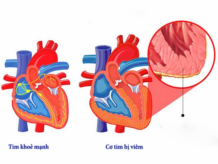 Vaccine phòng COVID-19 và viêm cơ tim- Tác dụng phụ có thể hóa giải - Ảnh 3. Vaccine phòng COVID-19 và viêm cơ tim- Tác dụng phụ có thể hóa giải - Ảnh 3.
