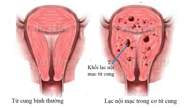 Lạc nội mạc tử cung có phòng tránh được không? - Ảnh 1.