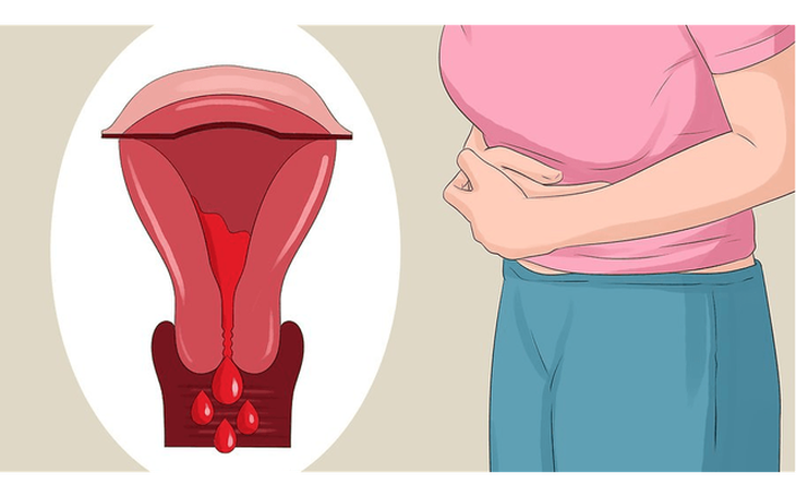 Niêm mạc tử cung lạc chỗ và dấu hiệu nhận biết sớm