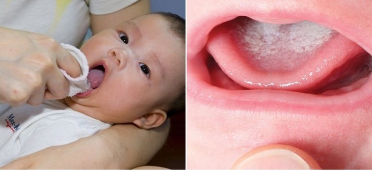 Vệ sinh đúng cách khi bé bị tưa miệng - Ảnh 1. Vệ sinh đúng cách khi bé bị tưa miệng - Ảnh 1.