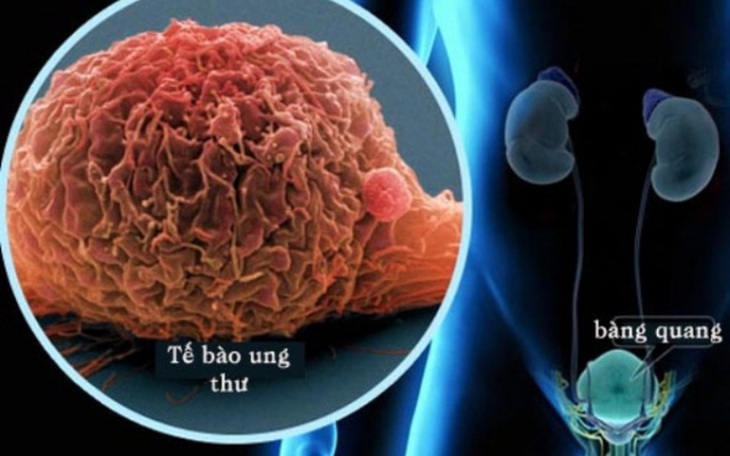Chuyên gia chỉ rõ việc bệnh nhân ung thư tiết niệu cần làm trong dịch COVID-19