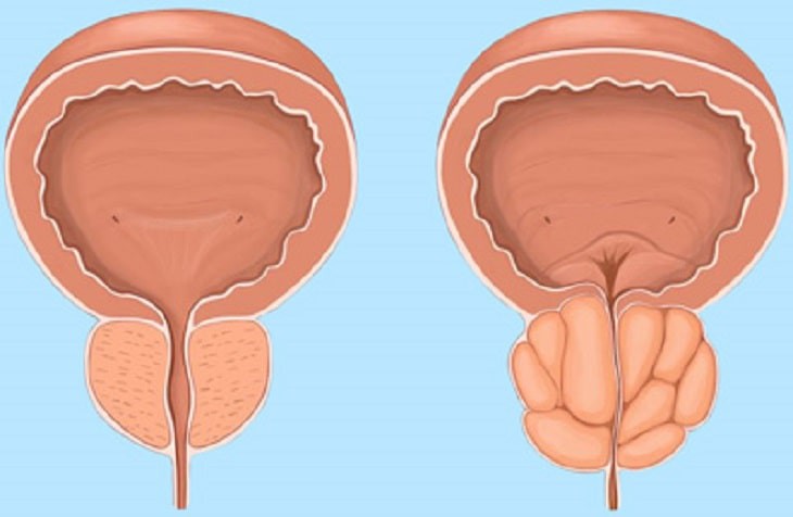 Nam giới tuổi trung niên và căn bệnh gây khó chịu: Phì đại tiền liệt tuyến - Ảnh 1. Nam giới tuổi trung niên và căn bệnh gây khó chịu: Phì đại tiền liệt tuyến - Ảnh 1.