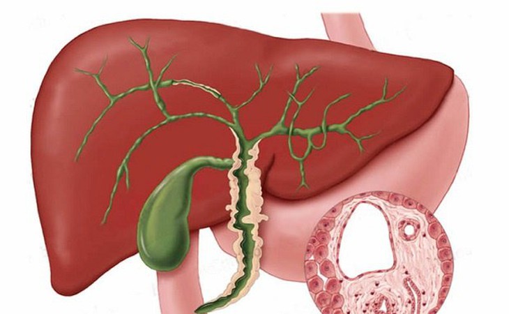 Liệu pháp điều trị ngứa ở bệnh nhân mắc bệnh gan hiếm gặp - Ảnh 1.