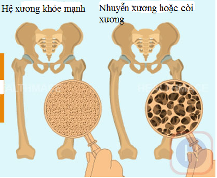 Nhận biết và phòng ngừa bệnh nhuyễn xương - Ảnh 1.