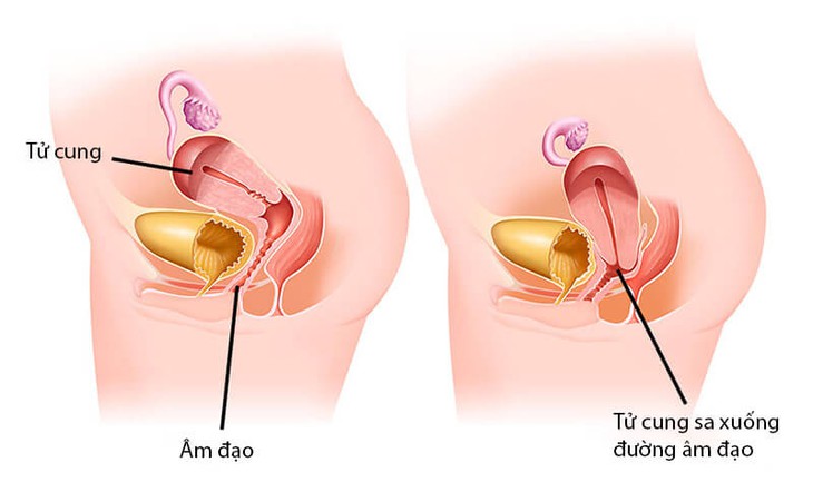 Sa tử cung và cách hỗ trợ phục hồi bằng Đông y - Ảnh 1.
