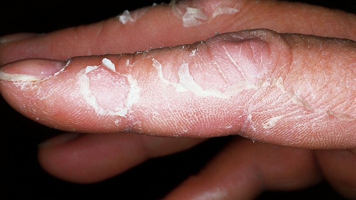 Bọng nước ở tay tái phát, bệnh gì? - Ảnh 2.