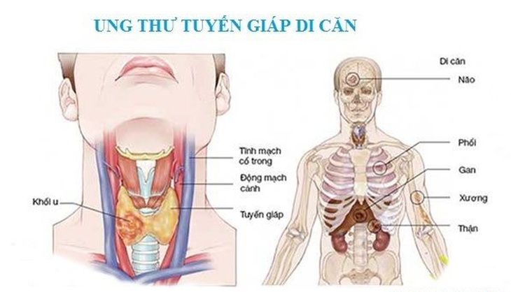 Ung thư tuyến giáp di căn sau 16 năm được cứu sống ngoạn mục - Ảnh 4.