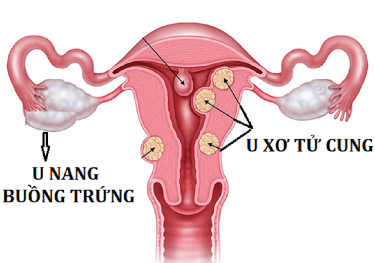 Nguyên nhân dậy thì sớm ở bé gái - Ảnh 3.