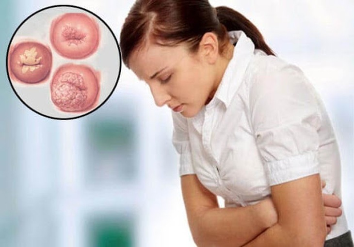 Viêm lộ tuyến tử cung và các cấp độ bệnh - Ảnh 1.