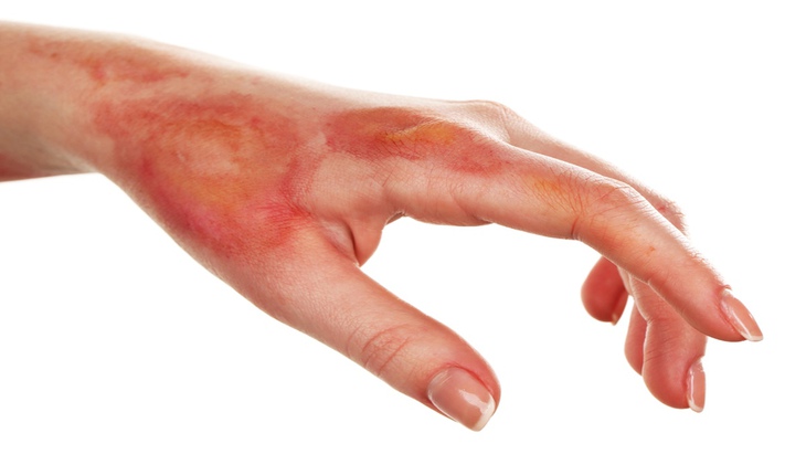 Liệu pháp ánh sáng giúp vết thương bỏng nhanh lành - Ảnh 1.