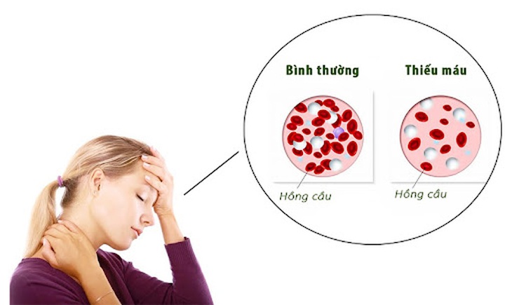 Ăn gì để hết mệt mỏi, hoa mắt, chóng mặt...? - Ảnh 2. Ăn gì để hết mệt mỏi, hoa mắt, chóng mặt...? - Ảnh 2.