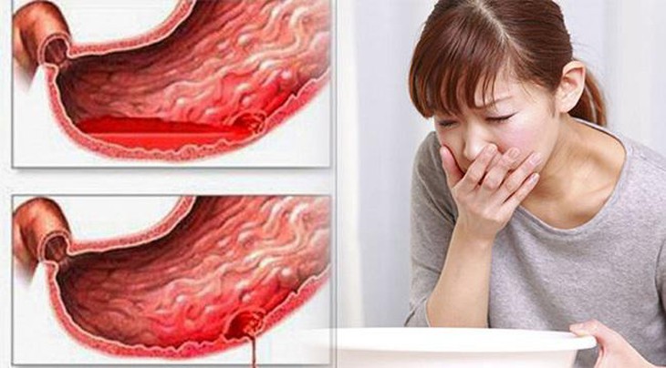 Nếu có những dấu hiệu này, coi chừng xuất huyết đường tiêu hóa nguy hiểm tính mạng - Ảnh 3. Nếu có những dấu hiệu này, coi chừng xuất huyết đường tiêu hóa nguy hiểm tính mạng - Ảnh 3.