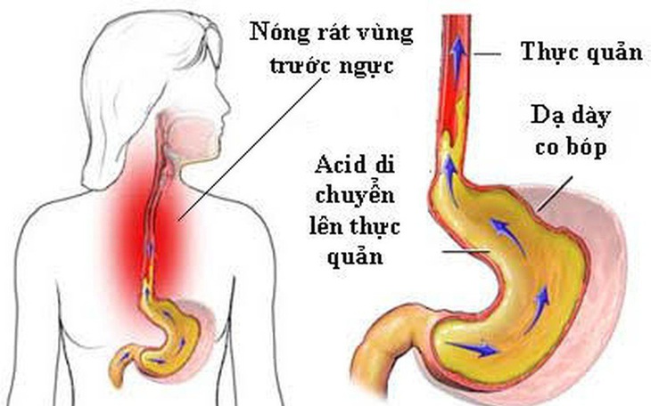 5 bài thuốc sắc trị trào ngược dạ dày thực quản