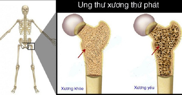 Loại ung thư nào dễ di căn xương? - Ảnh 2.