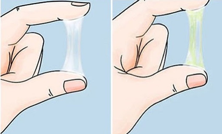 Huyết trắng khi nào cần điều trị? - Ảnh 1.