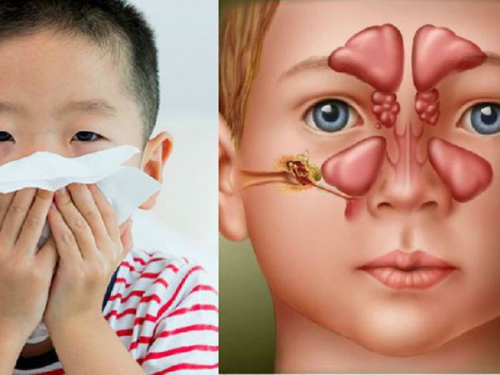 4 bài thuốc trị viêm xoang mạn tính trẻ em - Ảnh 1.
