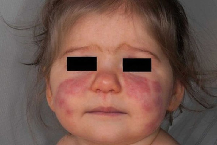 Trẻ mắc Lupus ban đỏ cần chăm sóc đúng cách - Ảnh 5.