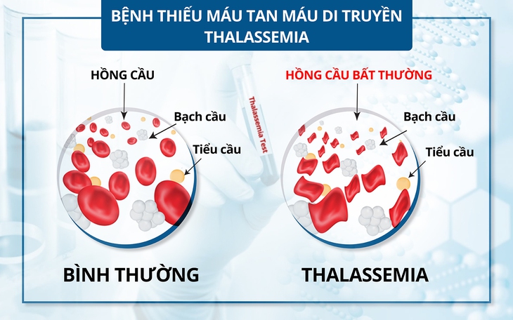 Chế độ dinh dưỡng phù hợp với người bệnh tan máu bẩm sinh chưa có biến chứng - Ảnh 2.