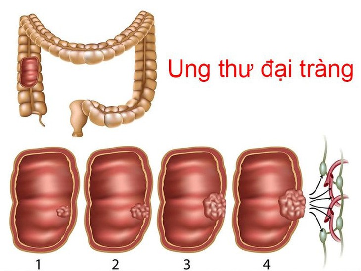 Các yếu tố nguy cơ của ung thư đại trực tràng - Ảnh 2.