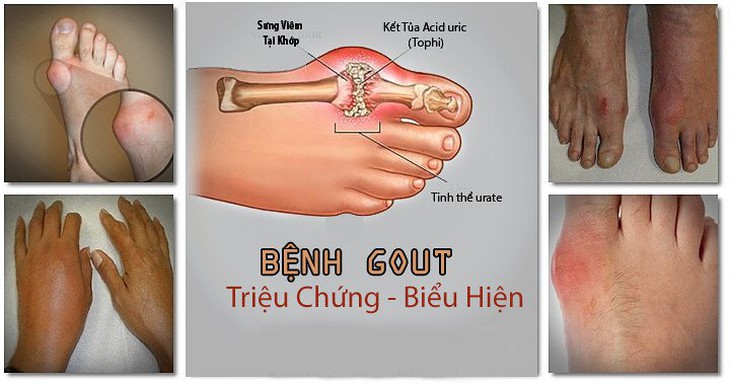 Biểu hiện thường gặp của bệnh gout cấp và cách xử trí - Ảnh 1.