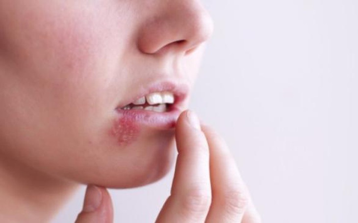 Bệnh mụn rộp sinh dục dễ nhầm với mụn nhọt thông thường 