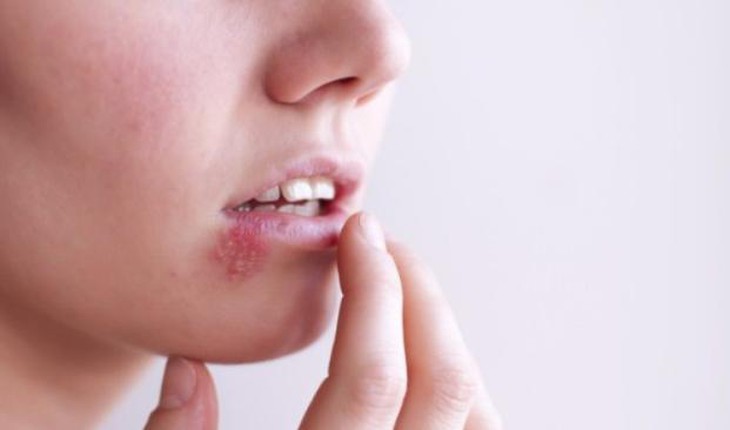 6 điều bạn nên biết về bệnh mụn rộp - ảnh 2