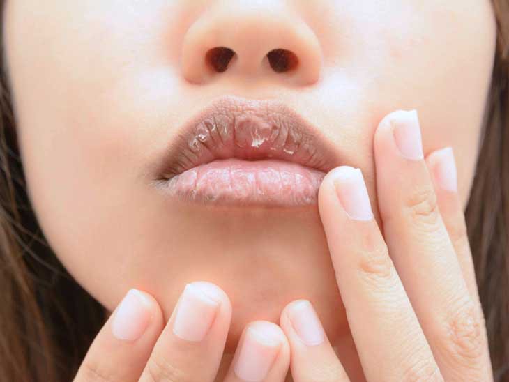 Thuốc nào điều trị viêm da môi bong vảy? - Ảnh 2.