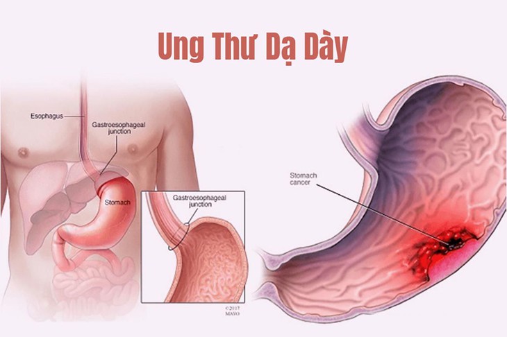 6 dấu hiệu của bệnh ung thư dạ dày khiến nhiều người chủ quan - Ảnh 1. 6 dấu hiệu của bệnh ung thư dạ dày khiến nhiều người chủ quan - Ảnh 1.